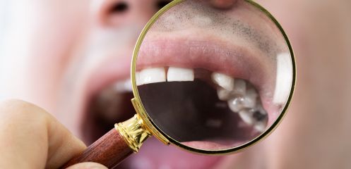 1–3 missing teeth with healthy neighbouring teeth